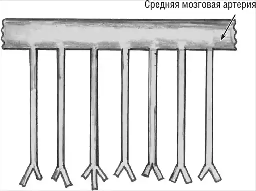 Хрупкий мозг. Инсульту не быть?